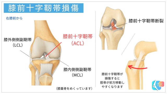 膝 前十字靭帯　ACL　
