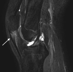 膝蓋靭帯炎　ジャンパー膝　ジャンパーズニー　jumpers knee MRI