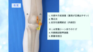 膝の痛み　膝内側