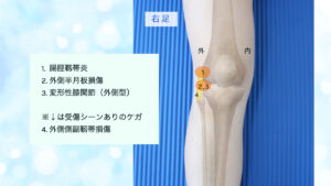 膝の痛み　膝外側