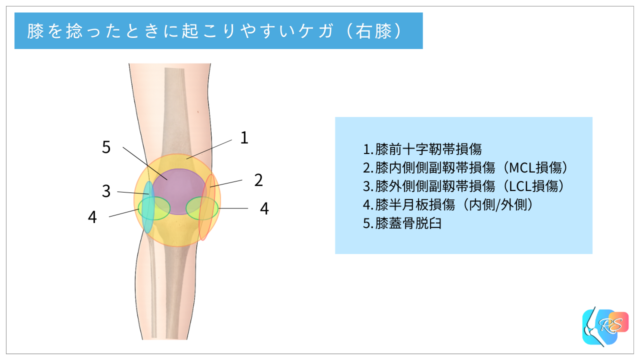 膝関節の急性外傷で起こりやすいケガと痛みの部位を示したイラスト