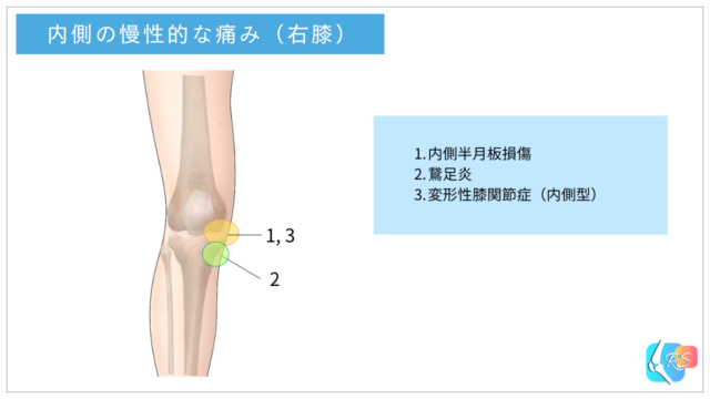 膝関節の慢性的な内側の痛みと代表的な原因を示した説明イラスト