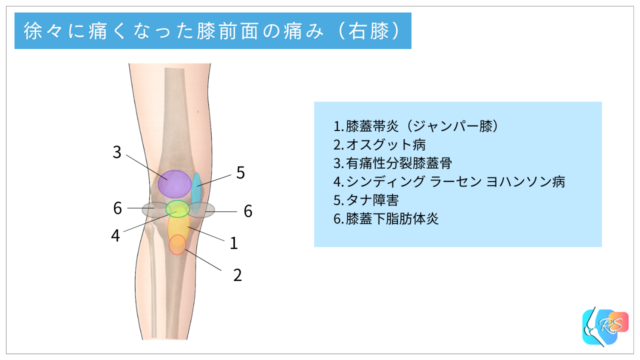 膝関節の慢性的な前面の痛みと代表的な原因を示した説明イラスト