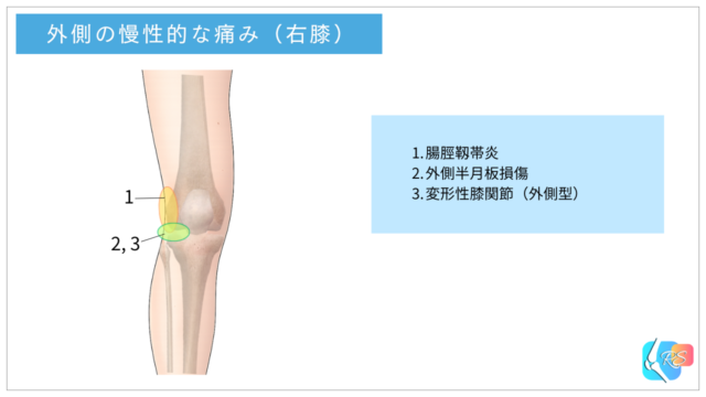 膝関節の慢性的な外側の痛みと代表的な原因を示した説明イラスト