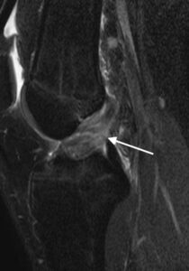 膝前十字靭帯損傷　膝ACL損傷　MRI
