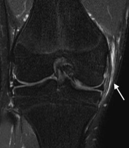 膝内側側副靭帯損傷　膝MCL損傷　MRI