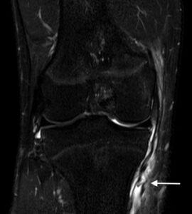 膝内側側副靭帯損傷　膝MCL損傷　MRI