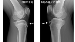 オスグット　レントゲン　画像　骨片　遺残