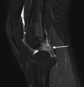 膝後十字靱帯損傷　膝PCL損傷　MRI