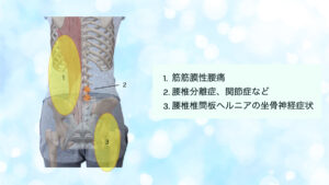 腰痛　腰　痛み
