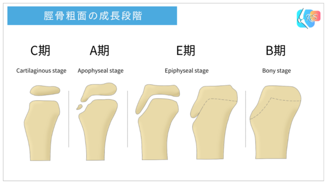 オスグット病における脛骨粗面の成長段階(C期・A期・E期・B期)を示したイラスト