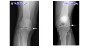 変形性膝関節症　膝OA　レントゲン　画像