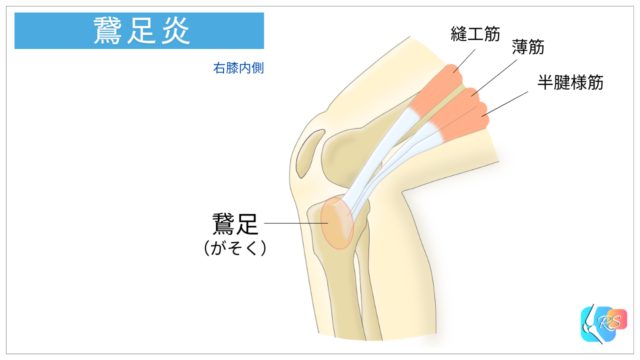 鵞足炎を説明するイラスト。縫工筋、薄筋、半腱様筋の3筋の付着部を鵞足と呼びます。