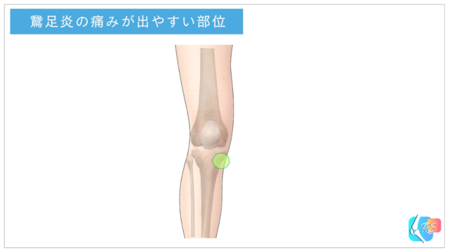 鵞足炎と痛みが出やすい部位のイラスト