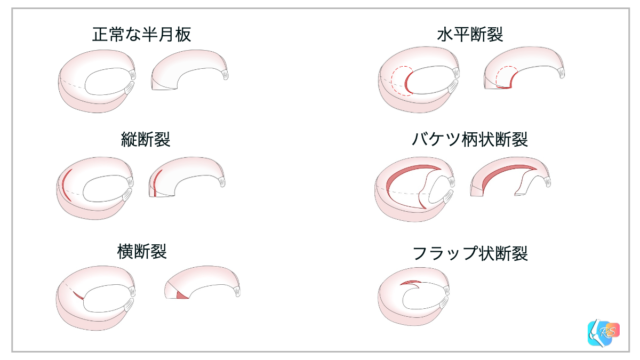 半月板損傷の症状・治療・復帰|膝が引っかかる・水がたまる