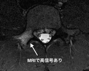 腰椎分離症　MRI