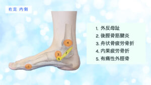 足の痛み　内側
