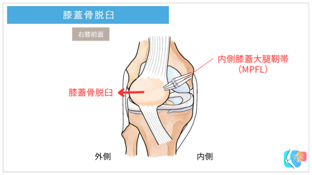 膝蓋骨脱臼と内側膝蓋大腿靭帯(MPFL)損傷の説明イラスト