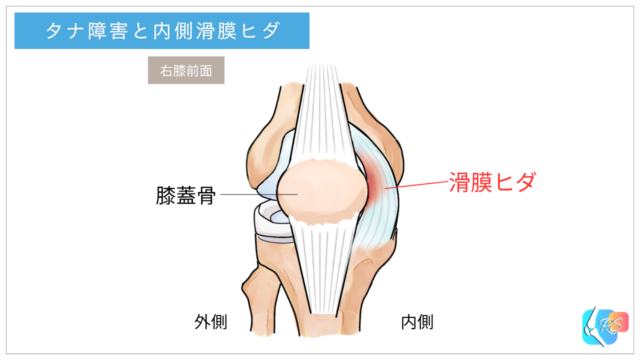 タナ障害のイメージ図｜膝内側の滑膜ヒダと痛み・引っかかり感