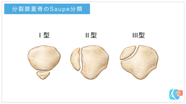 分裂膝蓋骨のSaupe分類を示したイメージ図。左からⅠ型、Ⅱ型、Ⅲ型