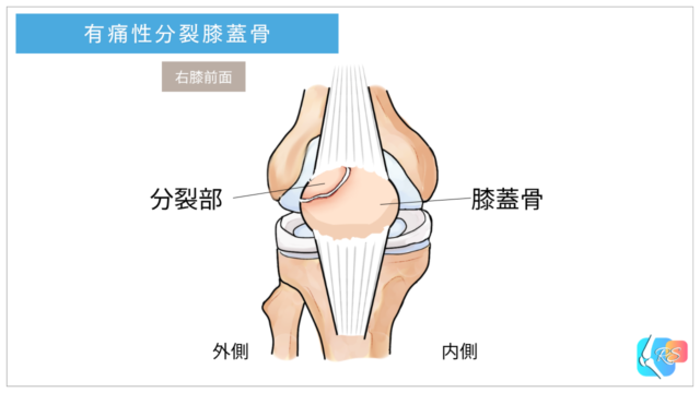 有痛性分裂膝蓋骨で膝蓋骨の一部が分裂している状態を示したイメージ図
