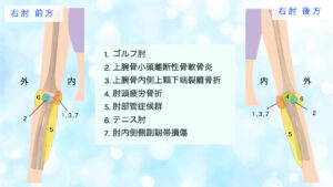 肘の痛み　部位