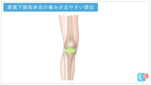 膝蓋下脂肪体炎で痛みが出やすい膝のお皿の下と膝蓋腱周囲を示したイラスト
