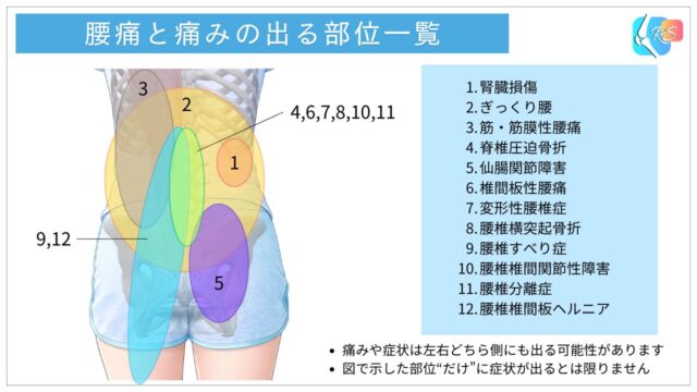 腰痛の疾患ごとに痛みが出やすい部位を示した図