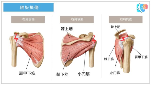 腱板を構成する筋（棘上筋・棘下筋・小円筋・肩甲下筋）を示した肩関節の解剖図