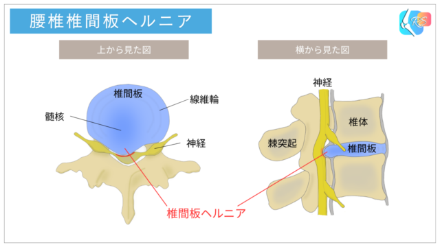 腰椎椎間板ヘルニアの解剖図|神経・髄核・線維輪・椎体・棘突起・椎間板の位置関係