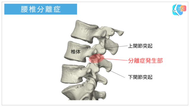 腰椎分離症の発生部位を示したイラスト｜椎間関節突起間部の骨ストレス障害