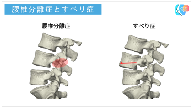 腰椎分離症と腰椎分離すべり症の違いを示したイラスト
