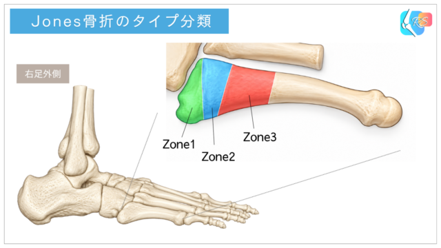 Jones骨折を含む第5中足骨近位部骨折のタイプ分類を示したイラスト