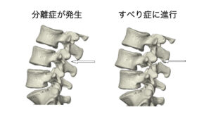 腰椎分離症　腰椎すべり症