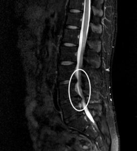 腰椎椎間板ヘルニア　MRI