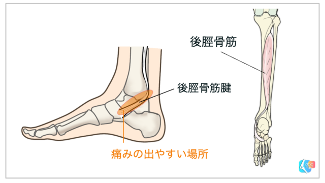 後脛骨筋腱炎とリハビリテーション