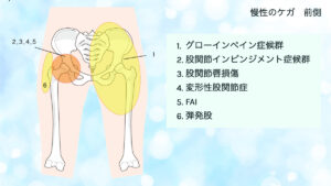 股関節の痛み　前面　グローインペイン　FAI　変形性股関節症