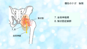 股関節のケガ　後面　梨状筋症候群