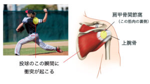 インターナルインピンジメント