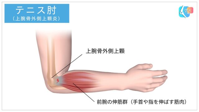 テニス肘（上腕骨外側上顆炎）で前腕伸筋群の腱が肘外側に付着し負荷がかかるイラスト