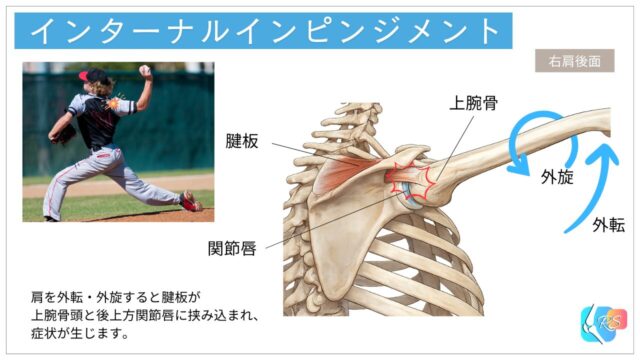 投球動作で肩が外転外旋した際に後上方で腱板と関節唇が接触するインターナルインピンジメントのイラスト