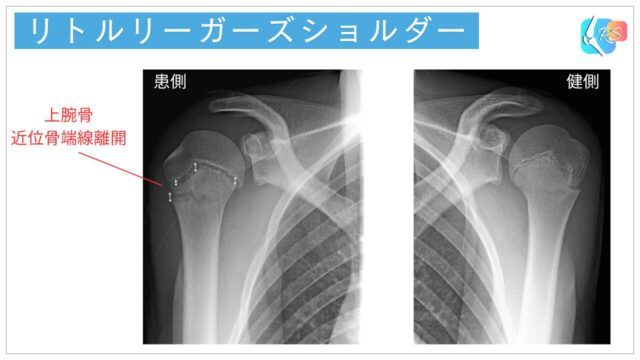 リトルリーガーズショルダーのレントゲン画像で、患側の上腕骨近位骨端線が健側より拡大している所見