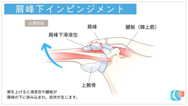 肩峰下インピンジメントで肩峰と上腕骨の間に腱板が挟まれる様子のイラスト