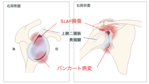 肩関節唇損傷