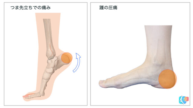 シーバー病　痛みの誘発