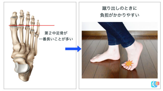 フライバーグ病