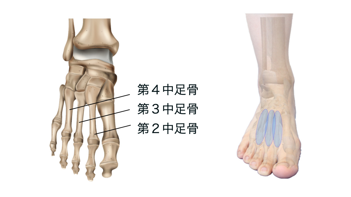 第5中足骨骨折の種類