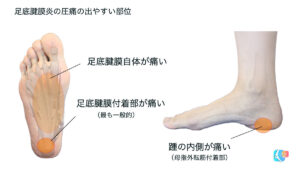 足底腱膜炎　圧痛部位