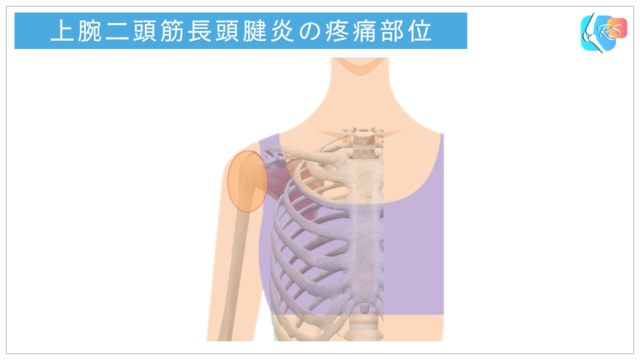 上腕二頭筋長頭腱炎で肩の前側に痛みが出やすい部位を示した図