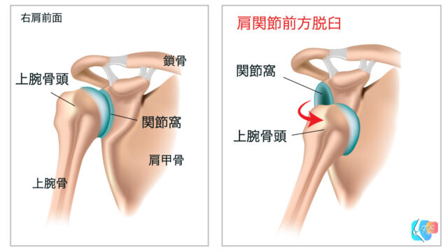 肩関節脱臼とリハビリテーション 肩関節脱臼とリハビリテーション
